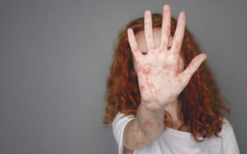 Outstretched hand covered in measles