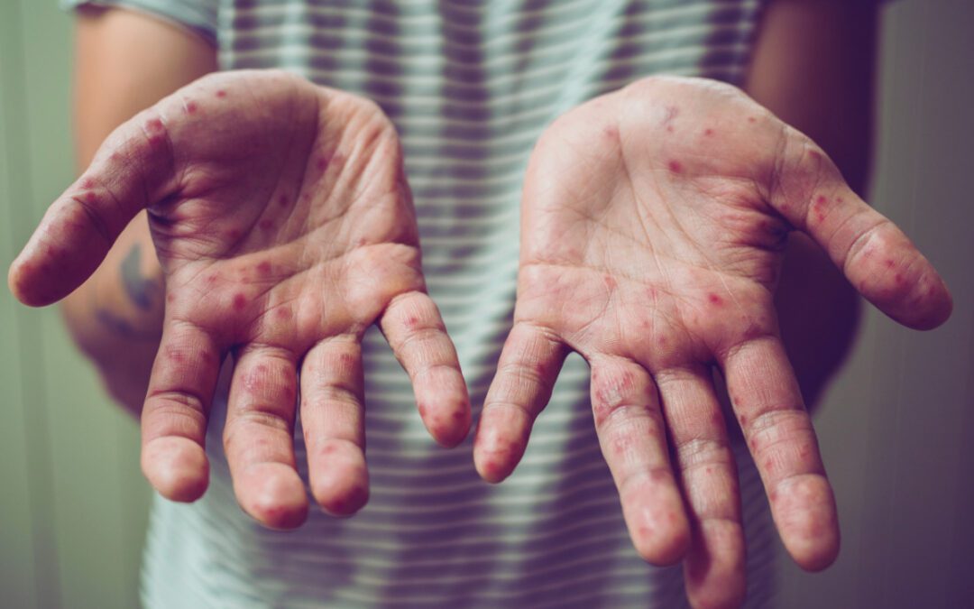 Michigan announces second measles outbreak as US hits 1,227 cases