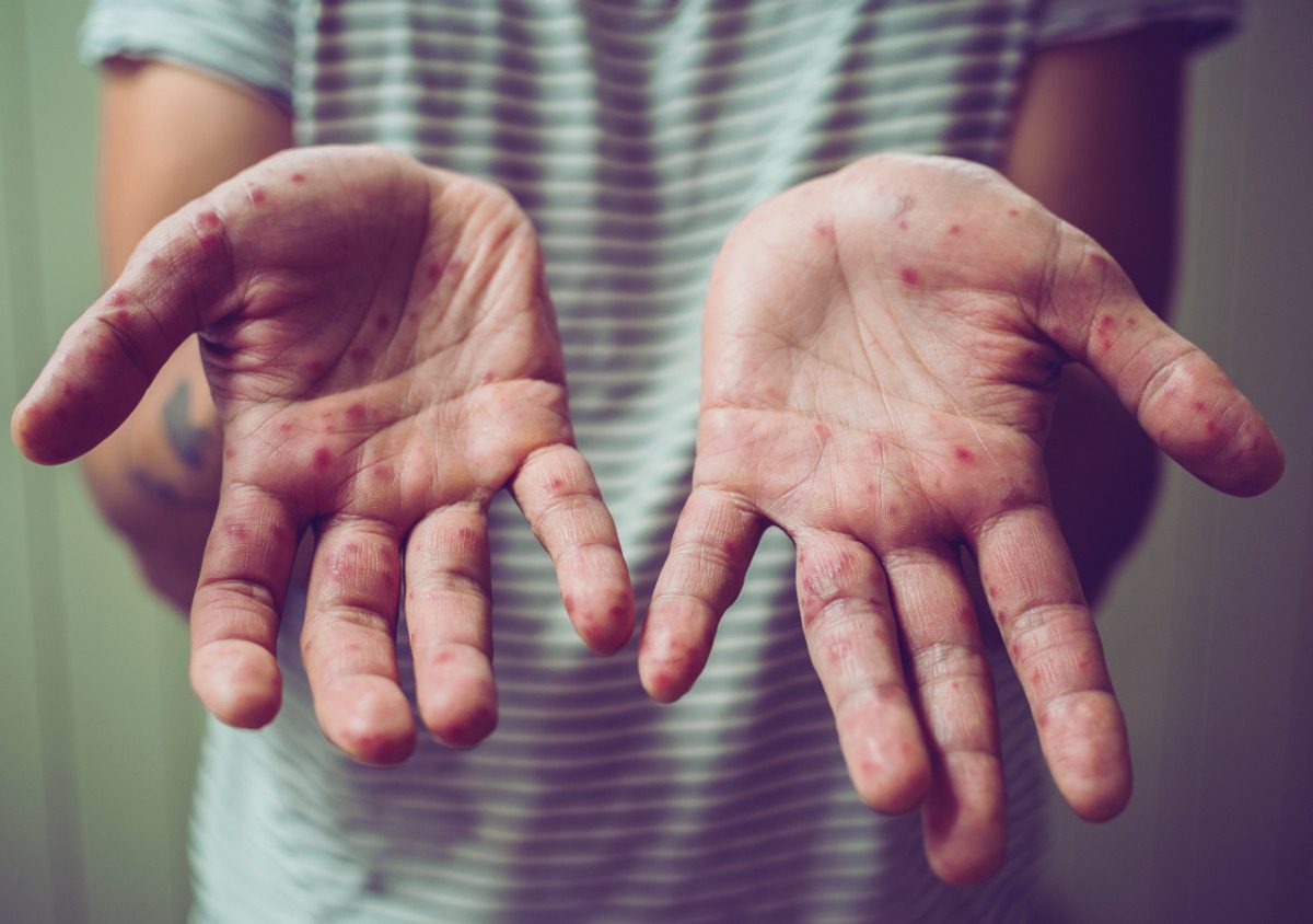 Michigan announces second measles outbreak as US hits 1,227 cases Michigan announces second measles outbreak as US hits 1,227 cases