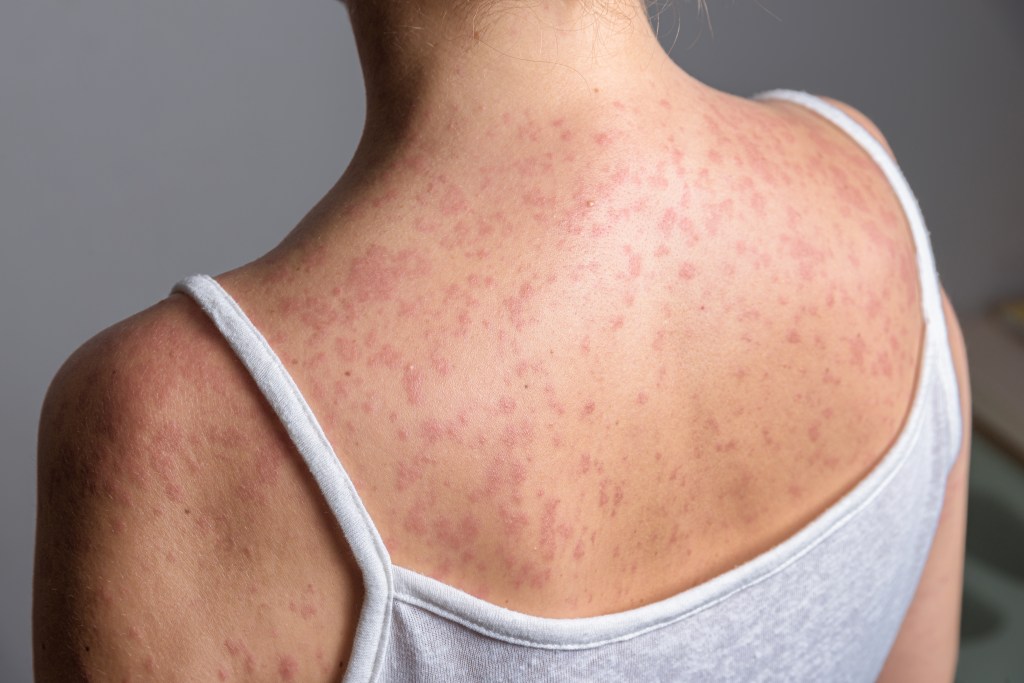 After another Michigan measles outbreak, a look at causes and solutions